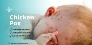 Chicken Pox