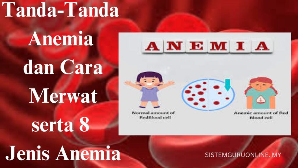 Tanda-Tanda Anemia Dan Cara Merawat Serta 8 Jenis Anemia