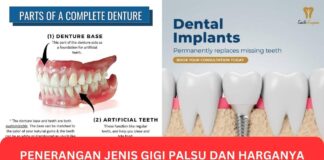 Penerangan Jenis Gigi Palsu dan Harganya Penerangan Jenis Gigi Palsu dan Harganya