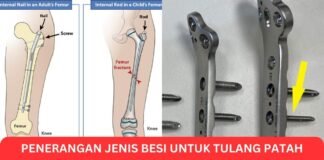 Penerangan Jenis Besi untuk Tulang Patah Dalam Perubatan Penerangan Jenis Besi untuk Tulang Patah Dalam Perubatan