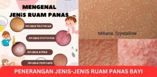 Penerangan Jenis-Jenis Ruam Panas Bayi Serta Dewasa dan Cara Rawat Ruam Panas Penerangan Jenis-Jenis Ruam Panas Bayi Serta Dewasa dan Cara Rawat Ruam Panas